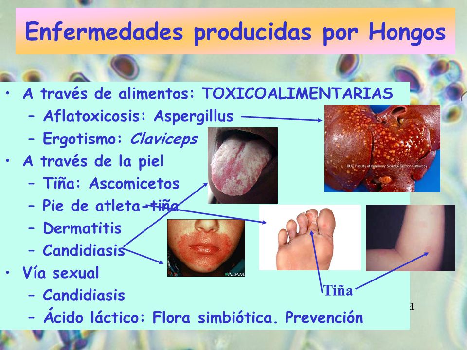 enfermedades producidas por hongos linear unit alimentos